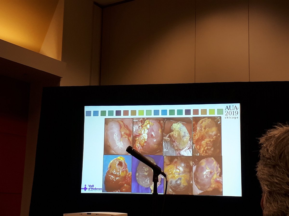 @MiretAlomar presenting at #aua19 the assesment of macroscopic aspect of kidney grafts and it's relation with DGF.