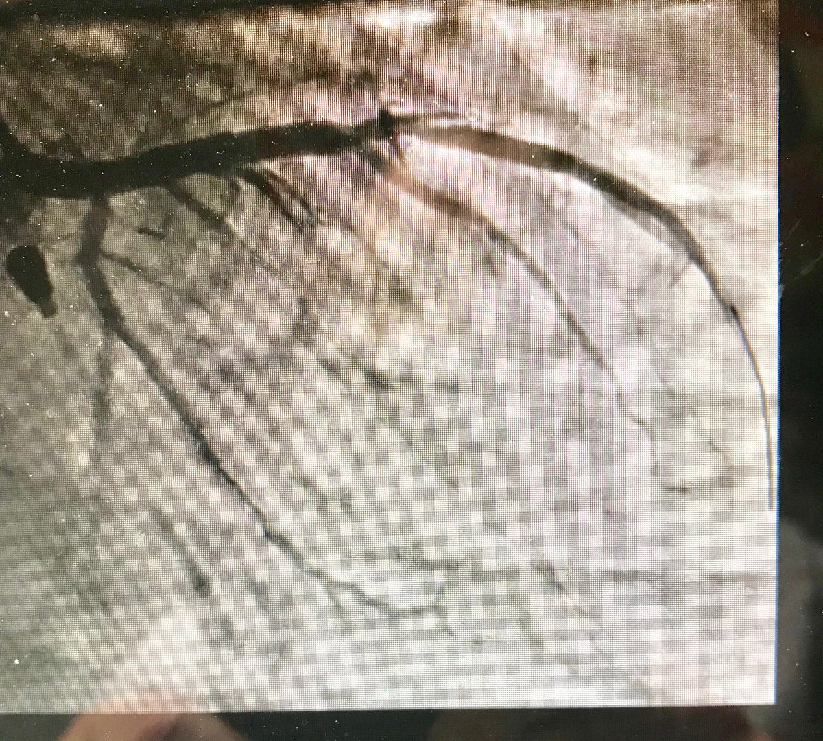 istentem's tweet image. 38m cp 30 hrs nstemi #RadialFirst opened LAD, brought back 2 weeks 7f guide #safefemoral #protectedpci #impella #ivus 4.5 DES in LAD&amp;gt;LM. Pot 5.0 #preclose home next day EF now 50