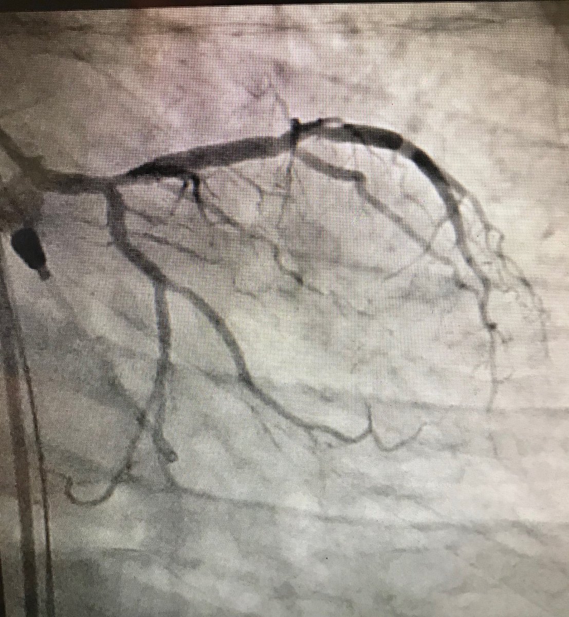 istentem's tweet image. 38m cp 30 hrs nstemi #RadialFirst opened LAD, brought back 2 weeks 7f guide #safefemoral #protectedpci #impella #ivus 4.5 DES in LAD&amp;gt;LM. Pot 5.0 #preclose home next day EF now 50