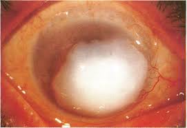 A "Corneal Keloid” is an extremely rare term; less than 100 cases have been documented since its first appearance in 1865! The term describes a epi-corneal lesion made up of fibrous tissue, collagen fibrils and glycoprotein.