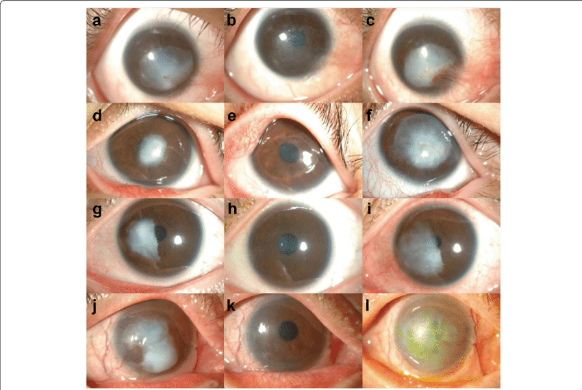 Corneal keloids can appear at any age, and vary in sizes. They may present as a single nodule, or go so far as to cover the entire stroma.