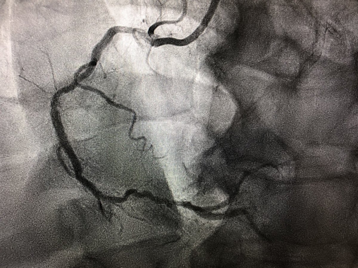 JMonteroMD's tweet image. First @ShockwaveIVL case today at @Hartcentrum @lumc in a challenging severely calcified RCA. Combination of debulking techniques key to success! TEAM work! #rotablator #rotatripsy #CHIP