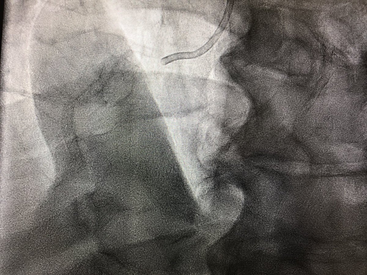 JMonteroMD's tweet image. First @ShockwaveIVL case today at @Hartcentrum @lumc in a challenging severely calcified RCA. Combination of debulking techniques key to success! TEAM work! #rotablator #rotatripsy #CHIP