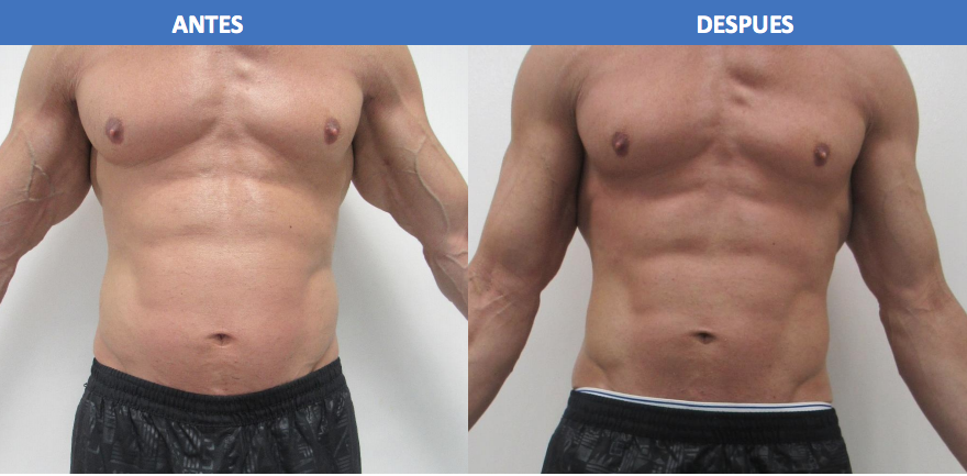 marthadebayle's tweet photo. Para los hombres también hay!!! aquí el before and after de 4 sesiones de Exilis Flancos + 4 sesiones de Vanquish. @CDIselaMendez https://t.co/vkPLDHvGIz