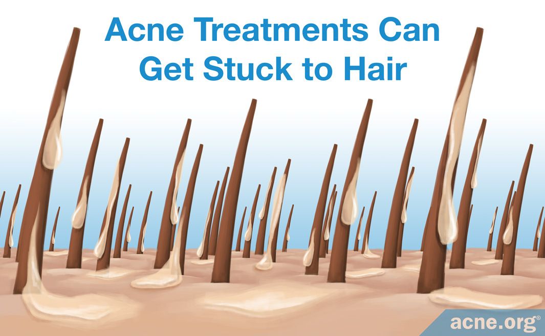 AcneOrg's tweet image. Treating acne with facial hair:

1. If you are willing to shave, or at the very least go to a close stubble, that's best

2. When you're applying medication, apply more, because some can get stuck to the hair, and do it gently.

acne.org/treating-acne-…