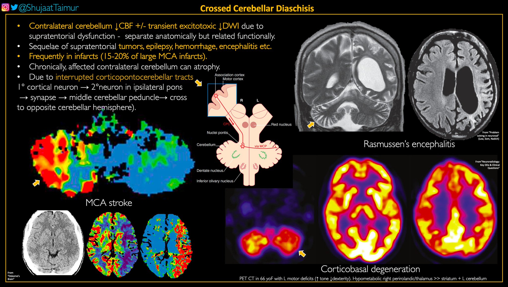 Ohio State Radiology A Informative Discussion Of Crossed Cerebellar Diaschisis Courtesy Of Our Very Own Shujaattaimur