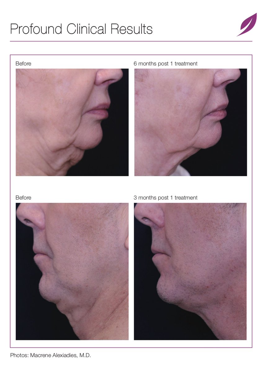 DistefanoSpa's tweet photo. More amazing results from #Profound!! https://t.co/opoh9kHYPX