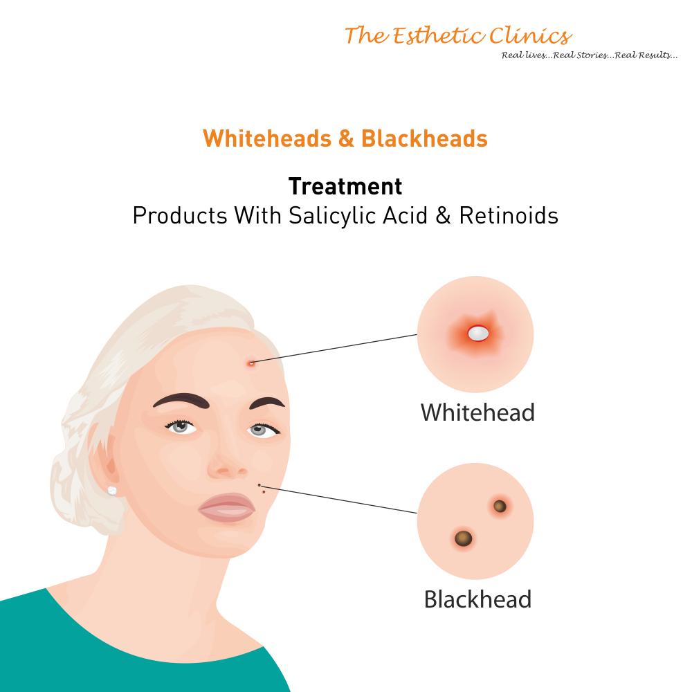 iamrinkykapoor's tweet photo. Contrary to popular opinion, #acne can be of many different types & each type has its own causes & treatments.
To get rid of acne permanently, get in touch with #DrRinkyKapoor. To book an appointment, call now at: +91-22-33756374
#TheEstheticClinics #Typesofacne #Treatments https://t.co/rKjCy8zlUA