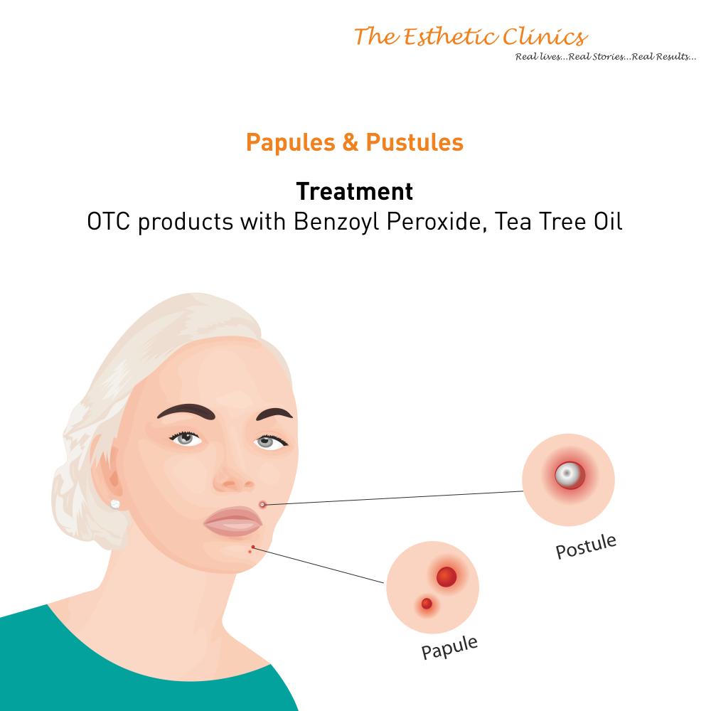 iamrinkykapoor's tweet photo. Contrary to popular opinion, #acne can be of many different types & each type has its own causes & treatments.
To get rid of acne permanently, get in touch with #DrRinkyKapoor. To book an appointment, call now at: +91-22-33756374
#TheEstheticClinics #Typesofacne #Treatments https://t.co/rKjCy8zlUA
