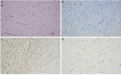 NAN_Wiley's tweet photo. Full access: First report of the neuropathological findings in a patient with #leukodystrophy & compound heterozygous variants in #PIGT gene https://t.co/6tw86xx1td https://t.co/w7E050GxRr
