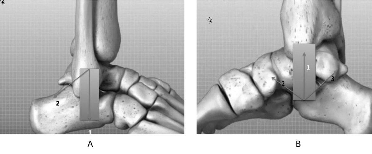 jrheum's tweet photo. Ultrasound of Subtalar Joint Synovitis in Patients with Rheumatoid Arthritis: Results of an OMERACT Reliability Exercise Using Consensual Definitions https://t.co/y0kDbdBM0Q #ultrasound #rheumatoidarthritis #subtalarjoint https://t.co/EepG4Ynvve