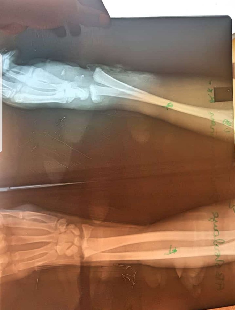 DraimeMbonda's tweet photo. Just receiving this young boy(15years). 4hrs open fracture in low ressources settings. Looking for #Orthopedics advices. Don't forget to think out of the box like @InvictaOrtho. #MedicalStudent #Orthopaedics #medtwitter #orthotwitter #AOtrauma #Incision #IncisionC https://t.co/b7WUJGLcP5