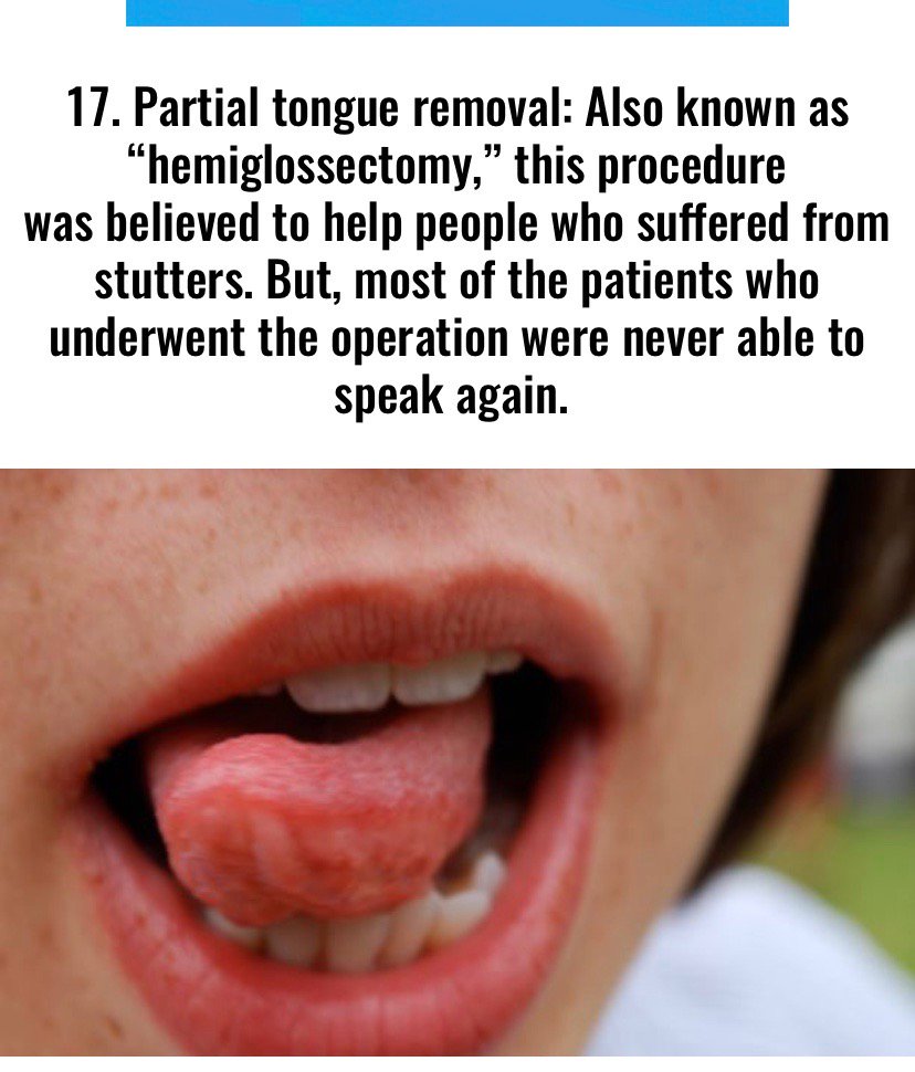 Partial tongue removal: Also known as “hemiglossectomy,” this procedure was believed to help people who suffered from stutters. But, most of the patients who underwent the operation were never able to speak again.