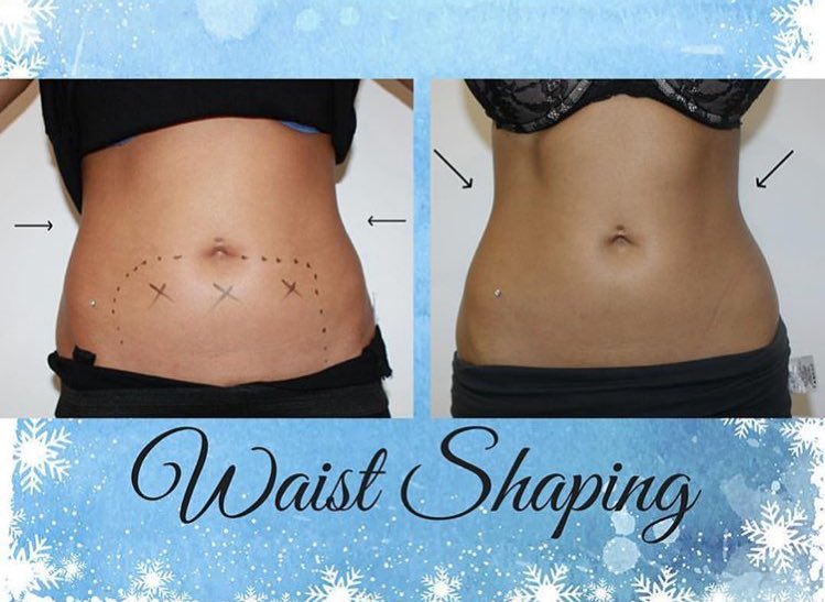 blushiouslondon's tweet photo. WAIST SHAPE &amp; CONTOUR 🤩
2 applicators were put on upper waist &amp; 1 on lower stomach ❗️ 😍👏 #bodyshaping #holiday #summer #summertime #richmond #kew #kewvillage #fatloss https://t.co/uHfDBvVK08