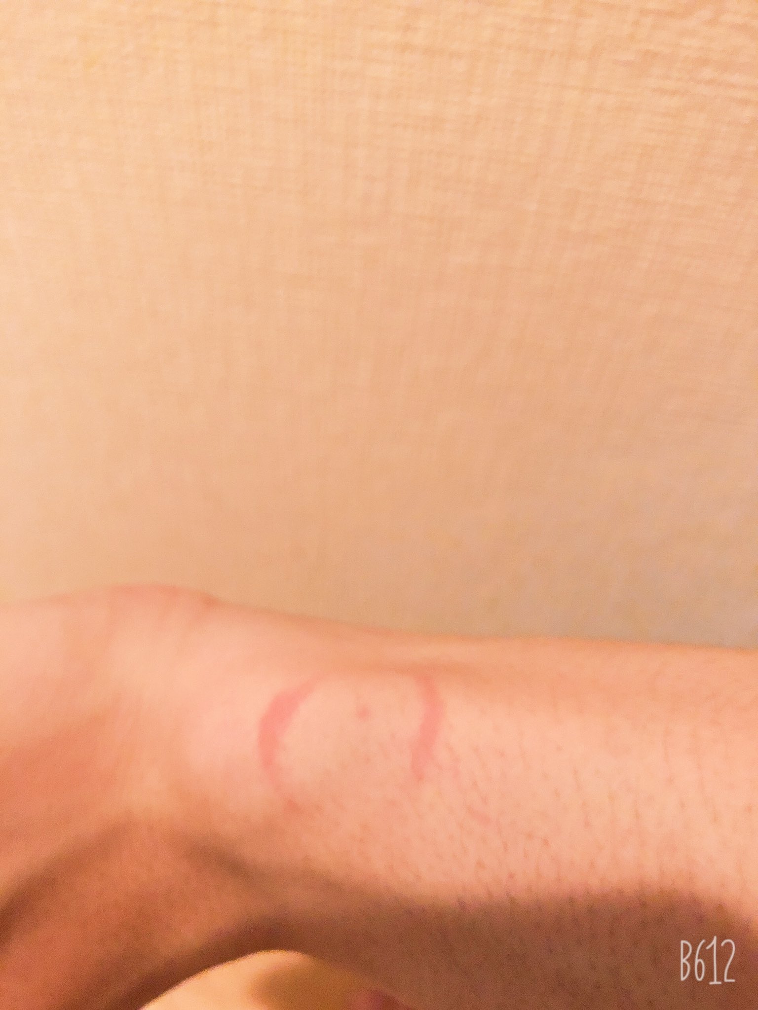 しゅーとん 蜘蛛に刺されました 蜘蛛踏み潰したった キスマークみたいなのなってる 毒抜きされただけなんだけどね 痛すぎたあ T Co H6tomsq0yx Twitter しゅーとん 蜘蛛に刺されました 蜘蛛踏み潰したった キスマークみたいなのなってる 毒抜きされただけなんだけどね 痛すぎたあ T Co H6tomsq0yx Twitter