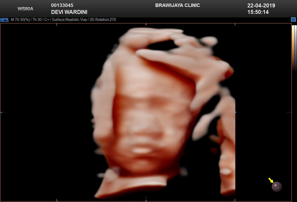 deviwardinii's tweet photo. Mirip siapa ya de, semoga sehat teruuss sayang #30weeks https://t.co/mzKgOQGA6e