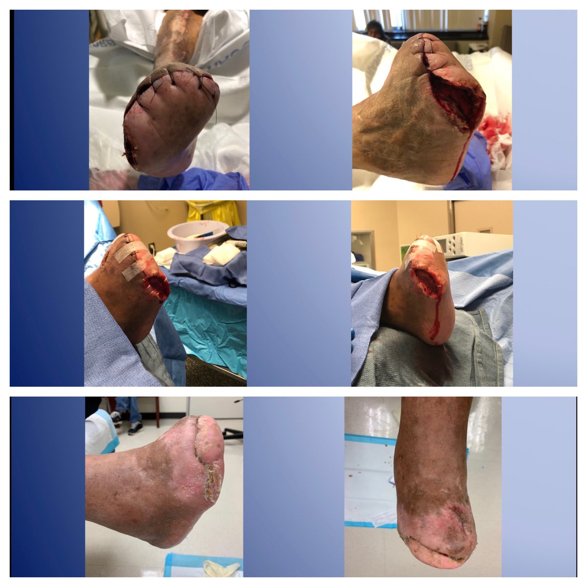 monteromiguel's tweet image. Always nice to see a healed patient s/p multilevel arterial intervention (ATA: retro crossing, #rotablator and 3.5/220 POBA), followed by beautiful foot scaping  by my toemigo Dr Lepow (@thetoedoctor) #STEP #BCMVascular #somosHENDOLAT #AmputationPrevention