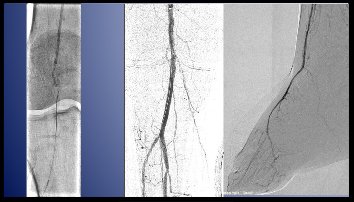 monteromiguel's tweet image. Always nice to see a healed patient s/p multilevel arterial intervention (ATA: retro crossing, #rotablator and 3.5/220 POBA), followed by beautiful foot scaping  by my toemigo Dr Lepow (@thetoedoctor) #STEP #BCMVascular #somosHENDOLAT #AmputationPrevention