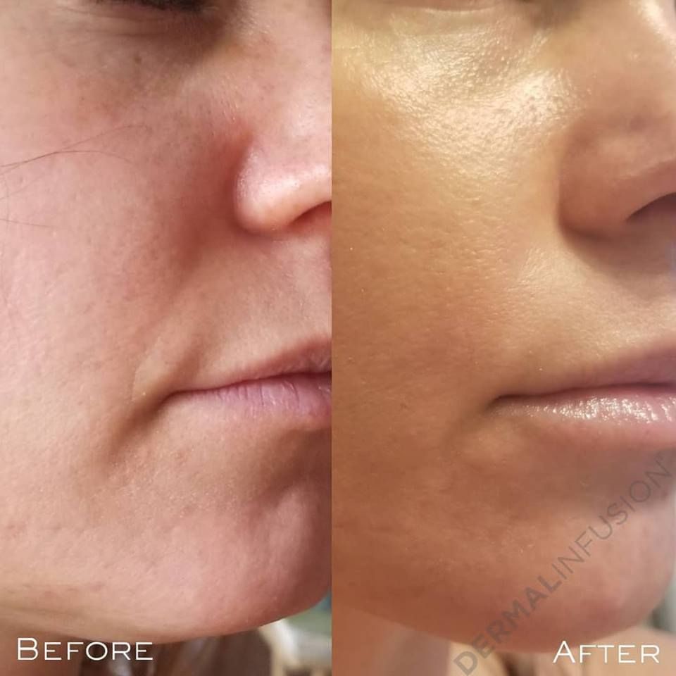 Check out the results after ONE Dermalinfusion treatment, the proof is in the pudding!  Coming SOON Follow us for news and info #skincareregime #skincareblogger #365skincare #iloveskincare #treatyourskin  #handandstonefacial #beautyobsessed #beautyroutine #beautyessentials