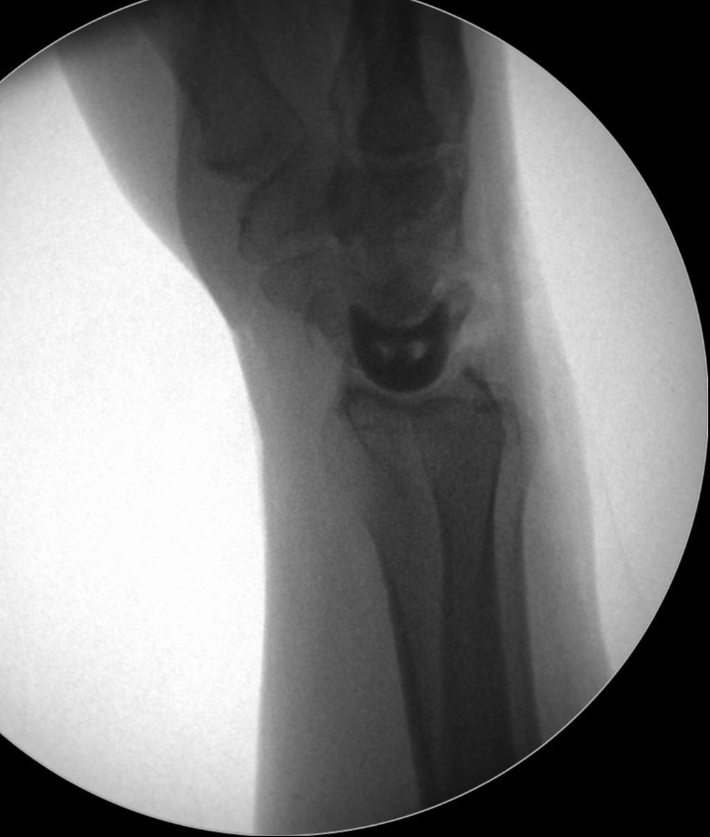 Homerton Orthopaedics (@huhorthopaedics) on Twitter photo Kienböck’s Disease - Avascular necrosis of the lunate can be a cause of wrist pain. Our specialist hand & wrist surgeon, Mr Arsan, has used a “lunate replacement” to relieve this patients pain 👏🏼#orthopaedics #wristpain #kienbocks <a href="/srt_homerton/">Homerton SRT</a> <a href="/NHSHomerton/">HHFT</a> <a href="/QIHomerton/">Homerton Improvement</a> Kienböck’s Disease - Avascular necrosis of the lunate can be a cause of wrist pain. Our specialist hand & wrist surgeon, Mr Arsan, has used a “lunate replacement” to relieve this patients pain 👏🏼#orthopaedics #wristpain #kienbocks <a href="/srt_homerton/">Homerton SRT</a> <a href="/NHSHomerton/">HHFT</a> <a href="/QIHomerton/">Homerton Improvement</a>