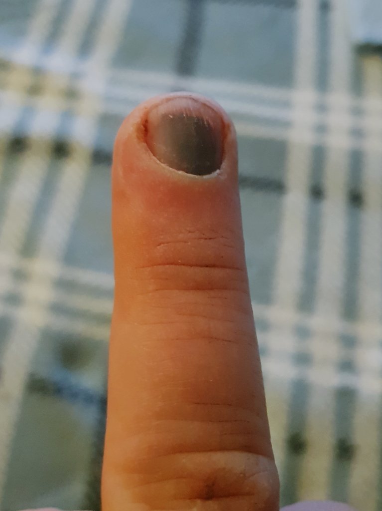 donnyjuff's tweet image. Well that&apos;s me not extending the patio this weekend as planned. Only dropped a fucking paving slab on it didn&apos;t I?! This also does not do justice to just how dark and how swollen it is #TwiceTheSize #CantBendIt #OuchAsFuck