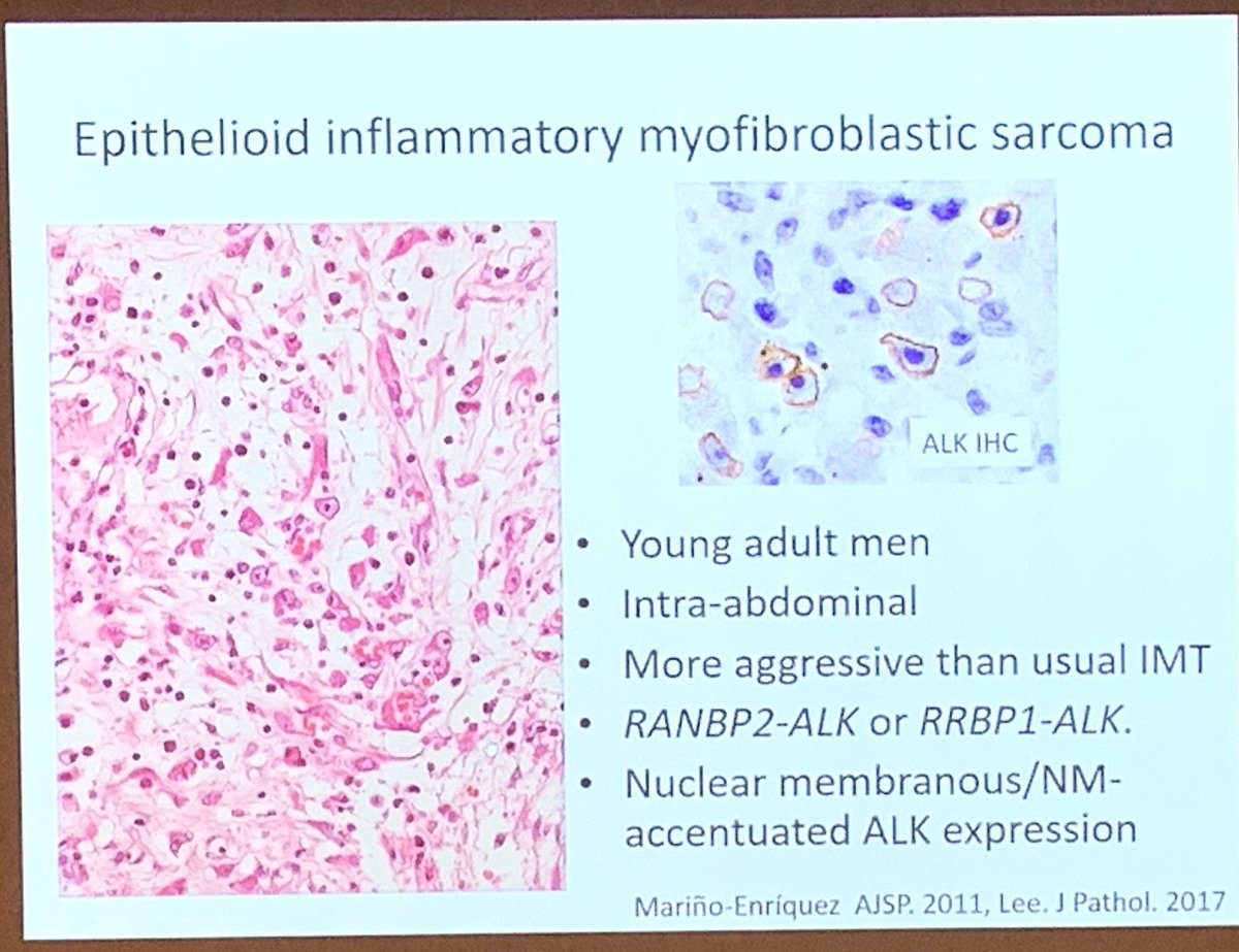 huda_rr1's tweet photo. #HKIAP Dr. Akihiko Yoshida.
Epithelioid inflammatory myofivroblastic sarcoma is an aggressive variant of inflammatory myofibroblastic sarcoma #SoftTissuePathology https://t.co/5An73CKcqs