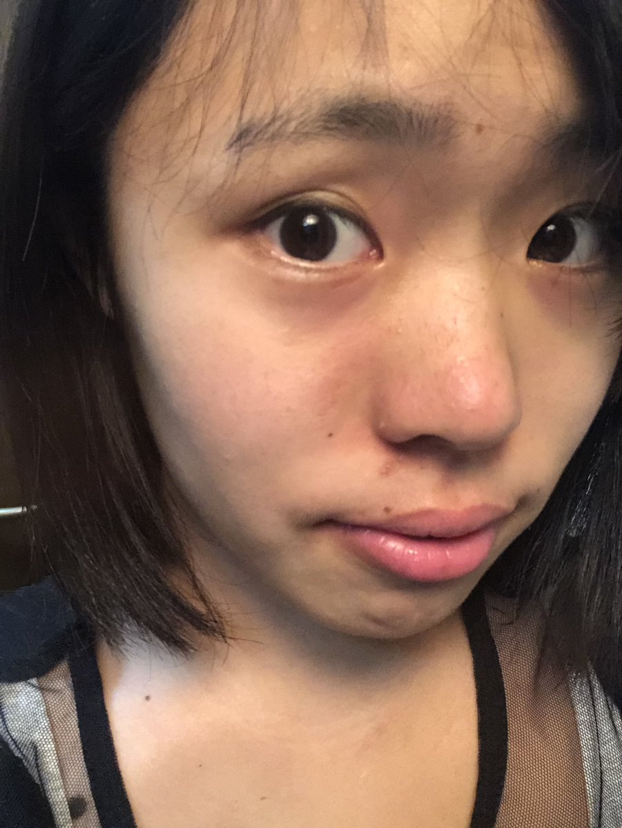 宮地あい on X: 10日目です。今日は家にいたので撮りました！4枚めが10日前の写真！顔の差がやばすぎる目の部分と口元が上がってますね！  t.coW9d3rw872W  X
