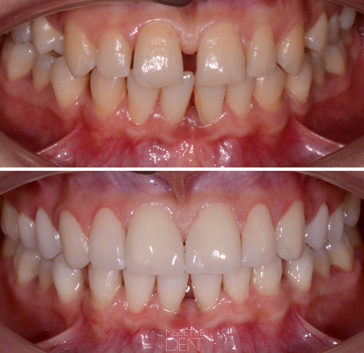 ‘Dişler ayrık olunca kısmet de açık olurmuş’ 🤪🤪🤪lafına hiç inanamıyoruz . @ nisbetiyedent #laminates #emax #hollywoodsmile #estheticdentistry 💕✨💕