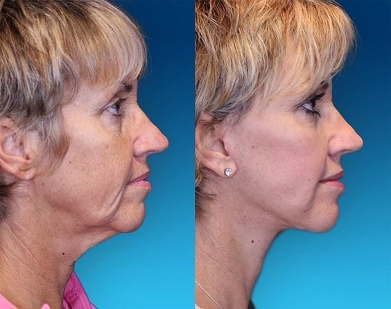 Facial Restoration Workout Techniques Will Revitalize These Face Areas - Utilize Them goo.gl/lWDvf