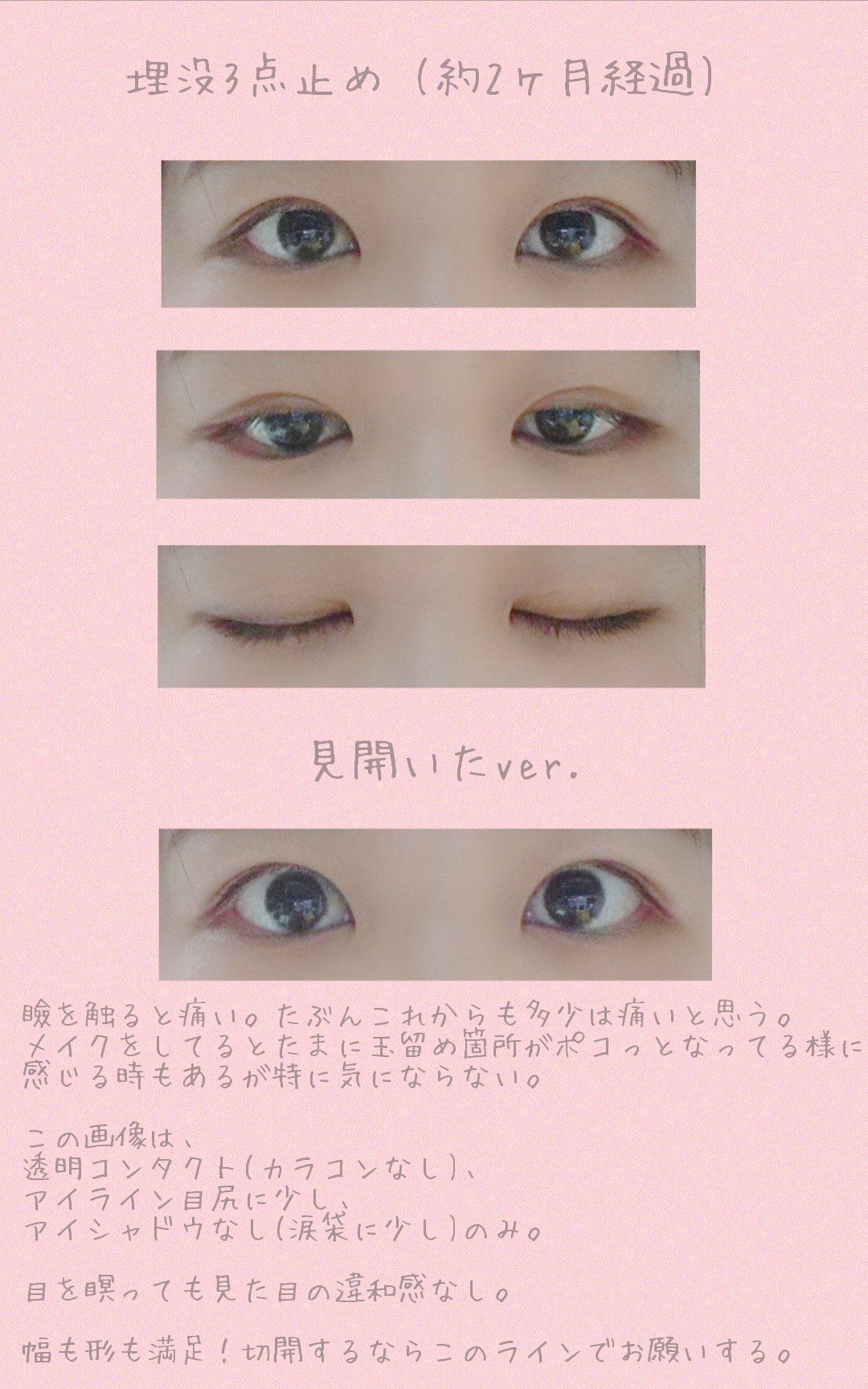 麗 埋没3点止め 済 埋没3点止め 約2ヶ月経過 超久しぶりの経過画像 見てお解りの通り アイプチの頃は目をガっと開けた方が盛れた 普段も写真の時も だけど埋没の今は力は入れずに ぼや っと目を開けてる方が二重ラインが見えて目が大きく