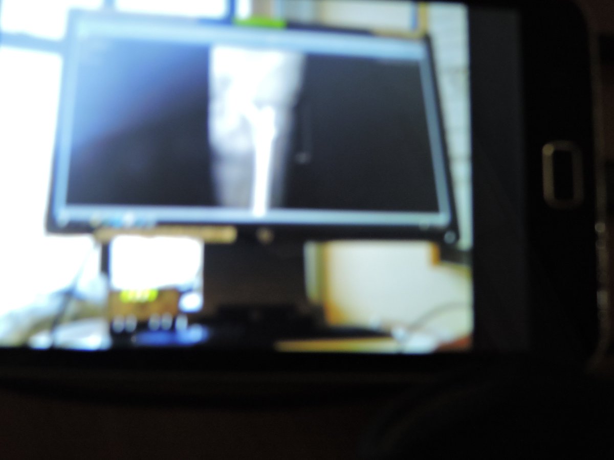 2016skipper's tweet image. On the road to recovery,a lot of metal, Too young to break hip. One thing saved me when I was in the hospital, watching Wentworth