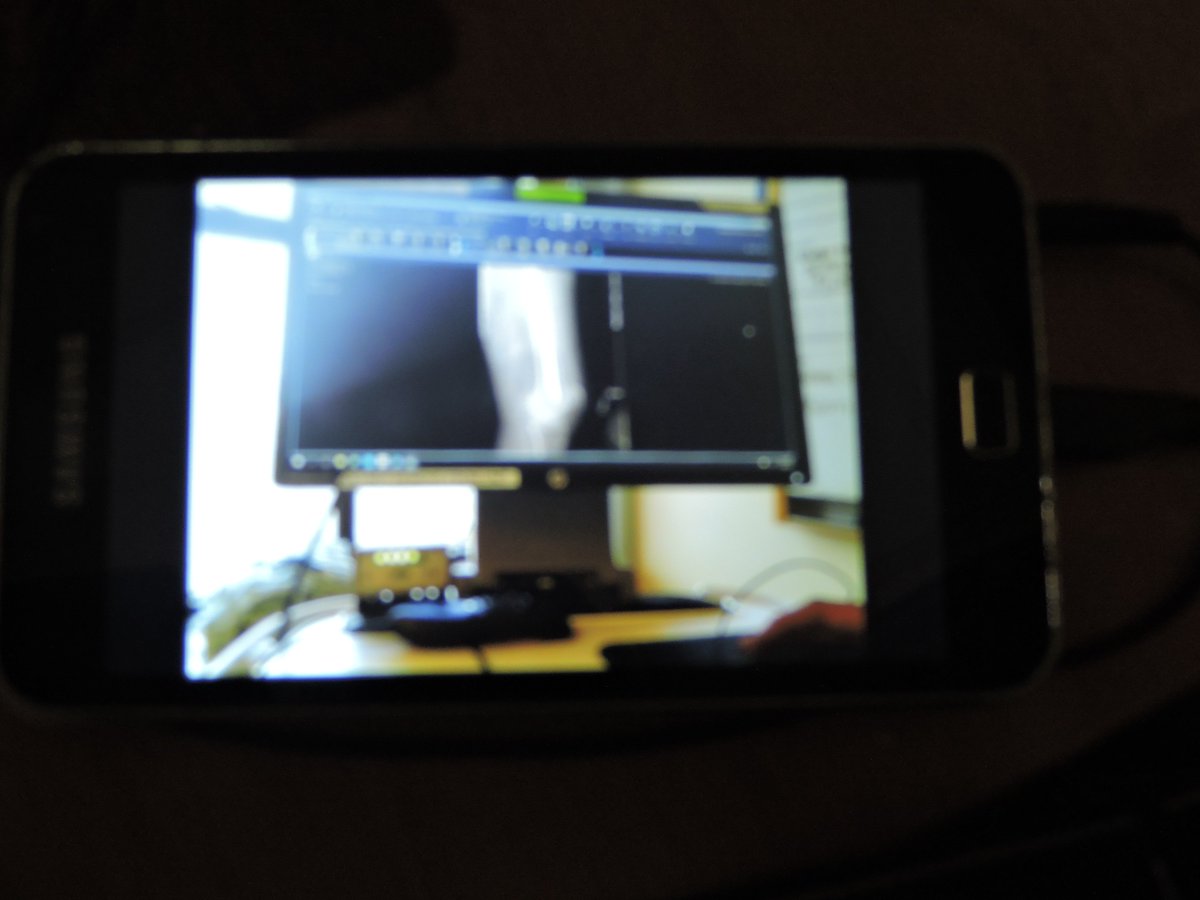 2016skipper's tweet image. On the road to recovery,a lot of metal, Too young to break hip. One thing saved me when I was in the hospital, watching Wentworth