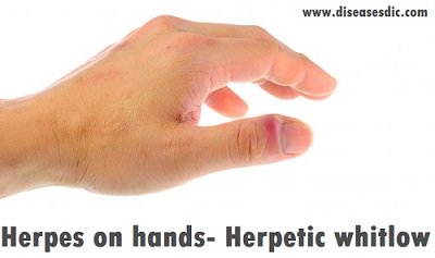 DiseasesTreatm3's tweet photo. What is Herpetic Whitlow?
Herpes on the hands!
Visit to know more about #Herpetic #Whitlow causes and treatment https://t.co/HdnU2R3e8t
#Virus #infection #herpes #Finger #pain #SYMPTOMS @ClevelandClinic @NHSEngland @JohnsHopkinsSPH @HopkinsKids @BBCSport @uclmedsci https://t.co/tEKpwcfx8A