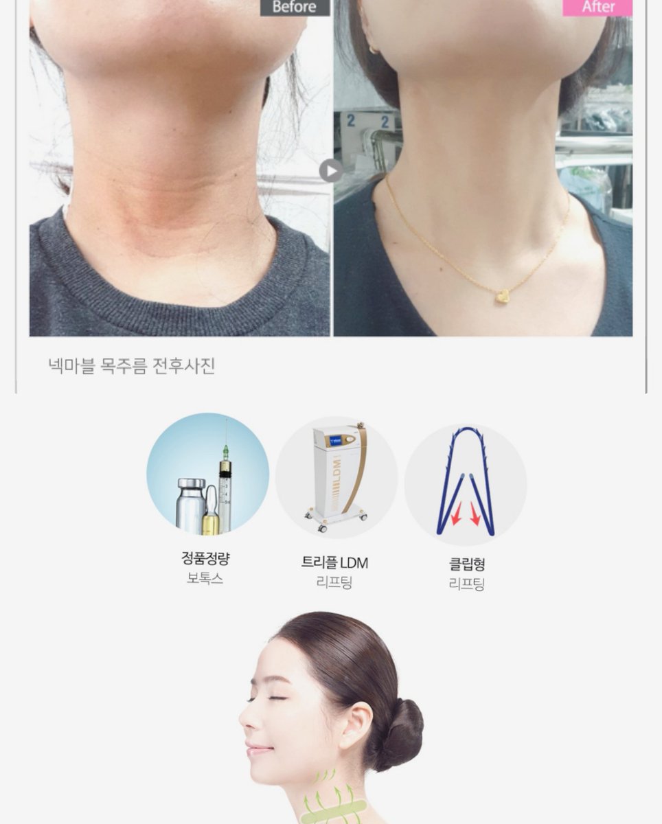韓国整形 Com Sur Twitter ボトックス Ldm クリップ型リフティングの3つの技術で深い首の皺も綺麗に こちらの病院現地価格ご案内可能 Line Zxy9602a 韓国美容整形 韓国整形 韓国整形通訳 韓国通訳 整形 美容整形 美容整形前後 韓国整形ガイド 韓国 韓国整形 Com Sur Twitter ボトックス Ldm クリップ型リフティングの3つの技術で深い首の皺も綺麗に こちらの病院現地価格ご案内可能 Line Zxy9602a 韓国美容整形 韓国整形 韓国整形通訳 韓国通訳 整形 美容整形 美容整形前後 韓国整形ガイド 韓国