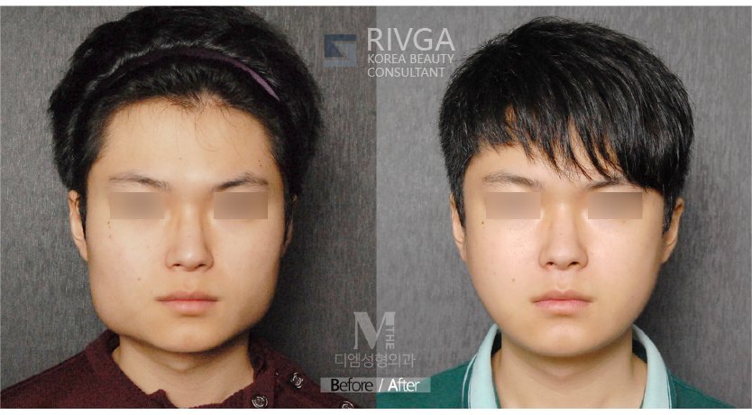 Korea Beauty Consultant Rivga ザエム症例写真ご覧ください 頬骨縮小 エラ削り 皮質切骨 男性整形