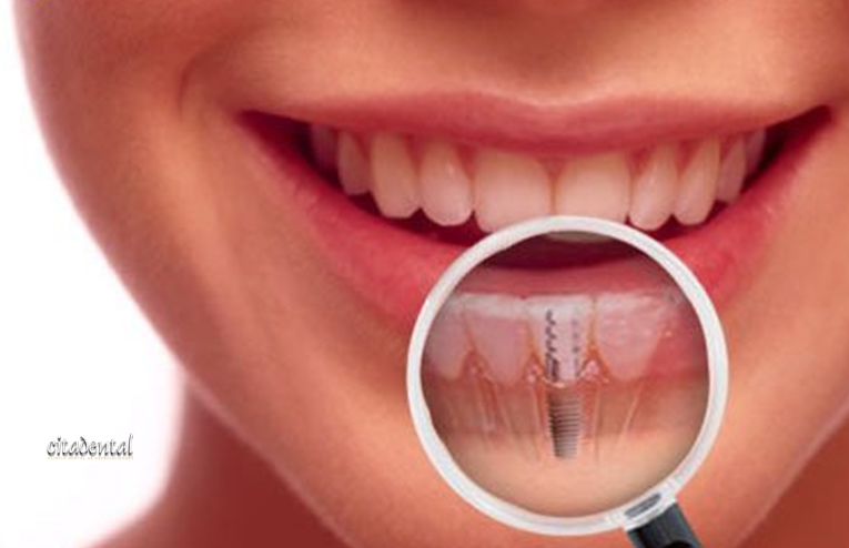 Citadental's tweet photo. En Odontología la #Implantología es un tratamiento muy exitoso para solventar la pérdida de un diente natural. Te hablamos de ella y aprovecha que durante el mes de mayo tenemos estudio implantológico radiográfico completo con escáner 3D gratuito. https://t.co/IVbAsnRBgV https://t.co/hwGoWgVK0L