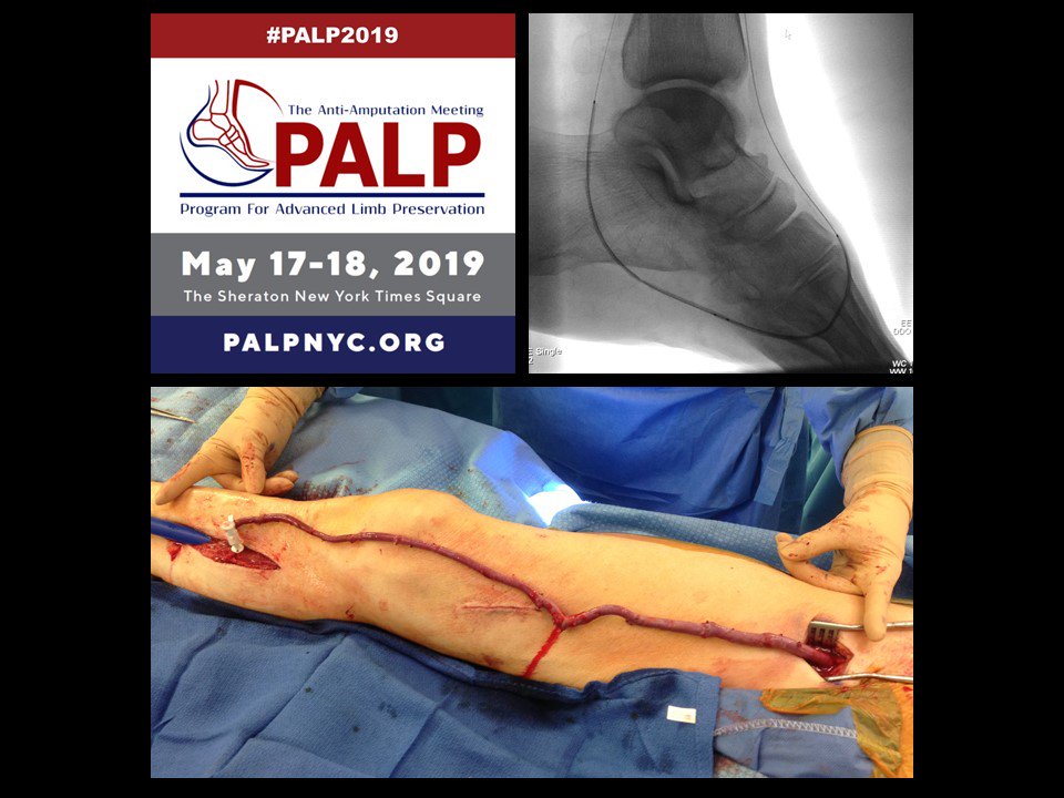 #PALP2019 - The #AntiAmputation Meeting is the can't miss #LimbPreservation meeting this year! Register now - less than a month away! #ComprehensiveVascularCare and #WoundCare for #CLTI and #DFU @PALPMeeting
