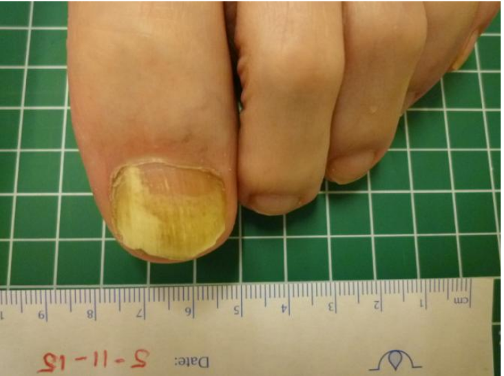 AdeAdamson's tweet photo. Laser therapy for onychomycosis in patients with diabetes at risk for foot ulcers: A randomised, quadruple‐blind, sham controlled trial (LASER‐1) https://t.co/KBLGY4BfLH topical and laser treatment of toe fungus are largely a waste of money and don't work well. https://t.co/VGJyeaSVq7