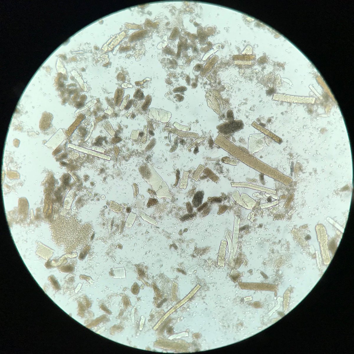 JoseTesser's tweet photo. Can you guess the serum creatinine? #urinalysis #urinesediment #aki #urinarycasts #nephrology #laboratorymedicine https://t.co/cwPM6aNKug