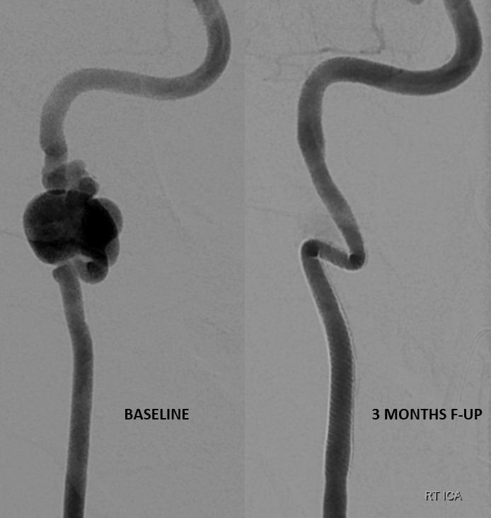 Eytan Raz (@eytanraz) on Twitter photo Ugly dissecting cervical internal carotid artery #aneurysm. Treated with multiple telescoped Pipelines #flowdiverter. 3 months follow-up showing new vessel. Just beautiful. <a href="/Medtronic/">Medtronic</a> <a href="/TheJNS/">Journal of Neurosurgery</a> <a href="/LINNConline/">LINNC online 🧠</a> <a href="/neurovexchange/">Neurovasc Exchange</a> <a href="/esmintsociety/">ESMINT Society</a> #FOAMed #FOAMrad #endovascular #ped Ugly dissecting cervical internal carotid artery #aneurysm. Treated with multiple telescoped Pipelines #flowdiverter. 3 months follow-up showing new vessel. Just beautiful. <a href="/Medtronic/">Medtronic</a> <a href="/TheJNS/">Journal of Neurosurgery</a> <a href="/LINNConline/">LINNC online 🧠</a> <a href="/neurovexchange/">Neurovasc Exchange</a> <a href="/esmintsociety/">ESMINT Society</a> #FOAMed #FOAMrad #endovascular #ped