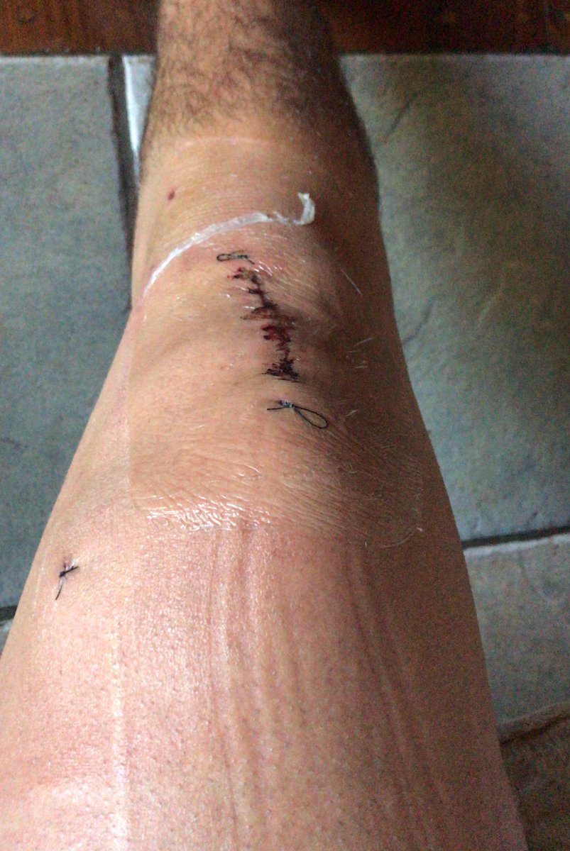 alejo9neno's tweet image. Rt o este año te rompes los ligamentos como yo 🔩❌