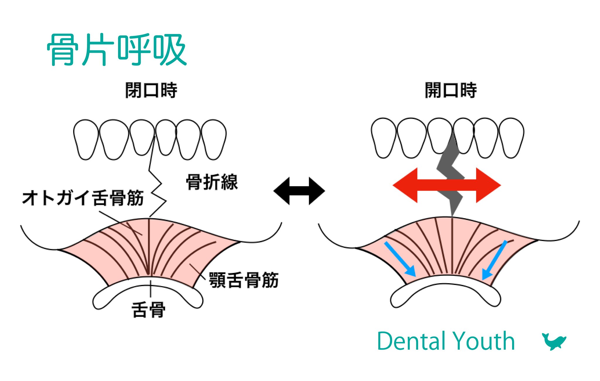 Dental Youth 歯科医師国家試験 Cbt 歯学部向け個別指導塾 Dental Youth Share 骨片呼吸 下顎正中部骨折では 骨片が筋肉に牽引され偏位します 開口時には顎舌骨筋に牽引されて正中離開 閉口時には離開してたものがとじます この