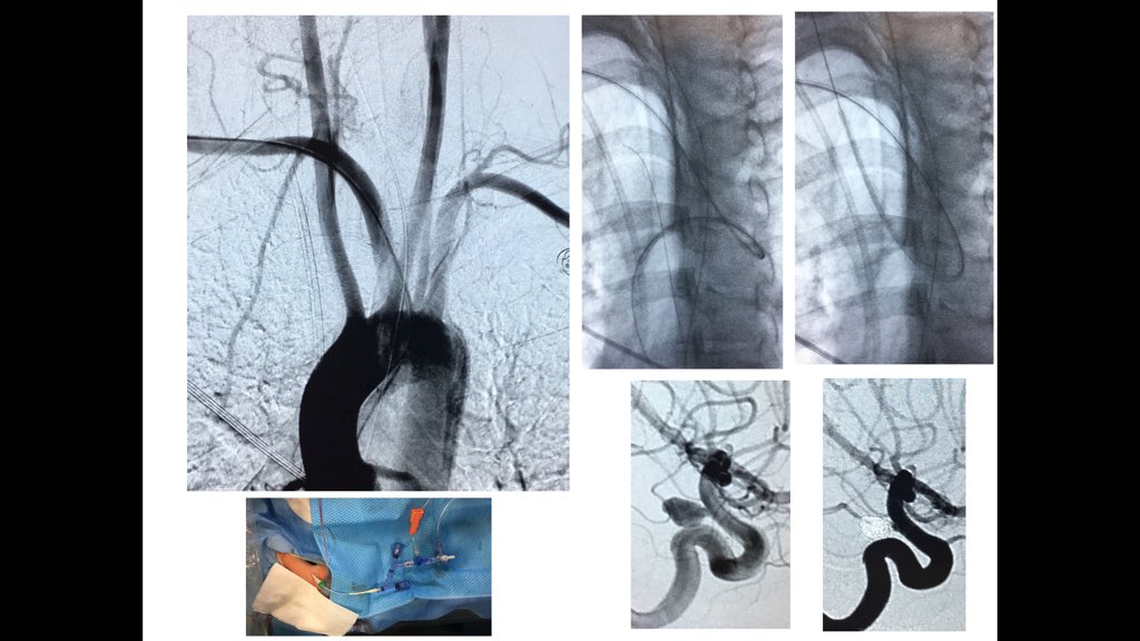 Roger Barranco Pons (@rbarrancopons) on Twitter photo 37yo female with SAH Fisher 4.right pcom aneurysm.
#RadialFirst #radialforneuro difficulties to get in right carotid>aortography: easy when anatomic variant is understood. Do you see it? <a href="/Oscarsabino/">Oscar Chirife</a> <a href="/saixut/">Sonia Aixut Lorenzo</a> <a href="/hbellvitge/">Hospital Universitari Bellvitge | HUB</a> 37yo female with SAH Fisher 4.right pcom aneurysm.
#RadialFirst #radialforneuro difficulties to get in right carotid>aortography: easy when anatomic variant is understood. Do you see it? <a href="/Oscarsabino/">Oscar Chirife</a> <a href="/saixut/">Sonia Aixut Lorenzo</a> <a href="/hbellvitge/">Hospital Universitari Bellvitge | HUB</a>