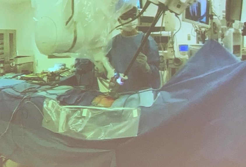 LeticiaRuizMD's tweet image. Observing Dr Kaouk performing #RoboticRadicalprostatectomy  single-port extraperitoneal #SPRobot  Supine position flat bed @ClevelandClinic