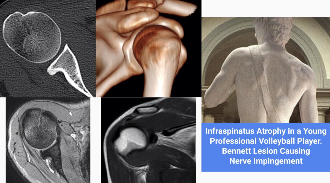 drwillyjara's tweet photo. Solution of my case today @MadridBoneClub: Infraspinatus Atrophy in a Young Professional Volleyball Player.
Bennett Lesion Causing
Nerve Impingement #mskrad #shouldermri #voleyball https://t.co/tirGz4ZtxV