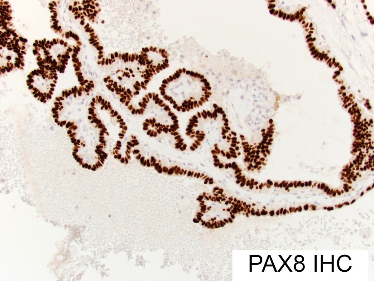 david_terrano's tweet photo. Straifhtforward case: Neck lesion & a "phone-call stain" confirms a history of thyroid carcinoma. PAX8, thyroglobluin show thyroid differentiation. Thyroglublin & PAX8 more specific vs. lung, but the history does the trick. #pathology #dermpath #Dermatology #AZDP https://t.co/oArX3vjTMy