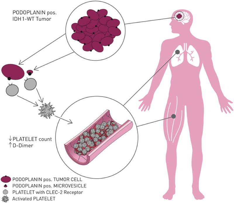 IDH1, Podoplanin &amp; Platelets are involved in thrombosis in brain tumors.
I´m reading "Venous Thromboembolism in Brain Tumors: Risk Factors, Molecular Mechanisms, and Clinical Challenges" 
thieme-connect.com/products/ejour…
#Cancer #thrombosis <a href="/podoplanin/">Podoplanin International Network</a> #braintumorawarenessmonth #Platelets