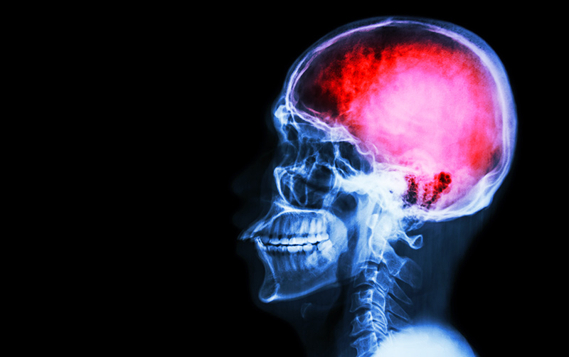 Jennife51190042's tweet photo. Is putting your health at risk really worth it? Not reporting a concussion will only make the situation worse. Make the health of a student athlete a priority! #ucr150 @saragrummert @Songling_GSOE https://t.co/GVyToJBNdn