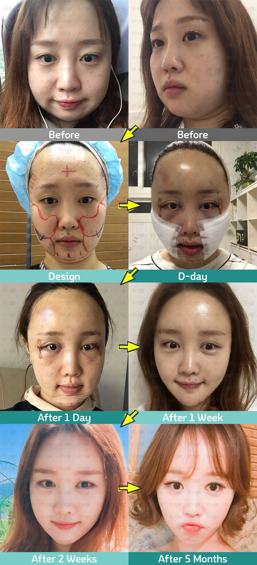 フレッシュ整形外科 On Twitter もたついた頬の肉 お客様に合わせて どこをどのように吸引するか正確にデザインして 確実に小顔に 効果絶大のアキュージェットｖ輪郭術 フレッシュ整形外科 脂肪吸引 ｖ輪郭術 小顔効果 韓国整形 美容整形