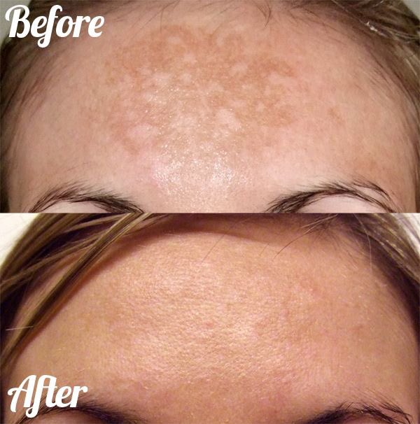 flamingo_jojo's tweet photo. Do you have pigmentation due to sun damage? Have you tried Microdermabrasion? 
Contact me now to arrange an appointment at home 
#newskin #smoothskin #radiant #readyforanything https://t.co/JwCyy7qmkT